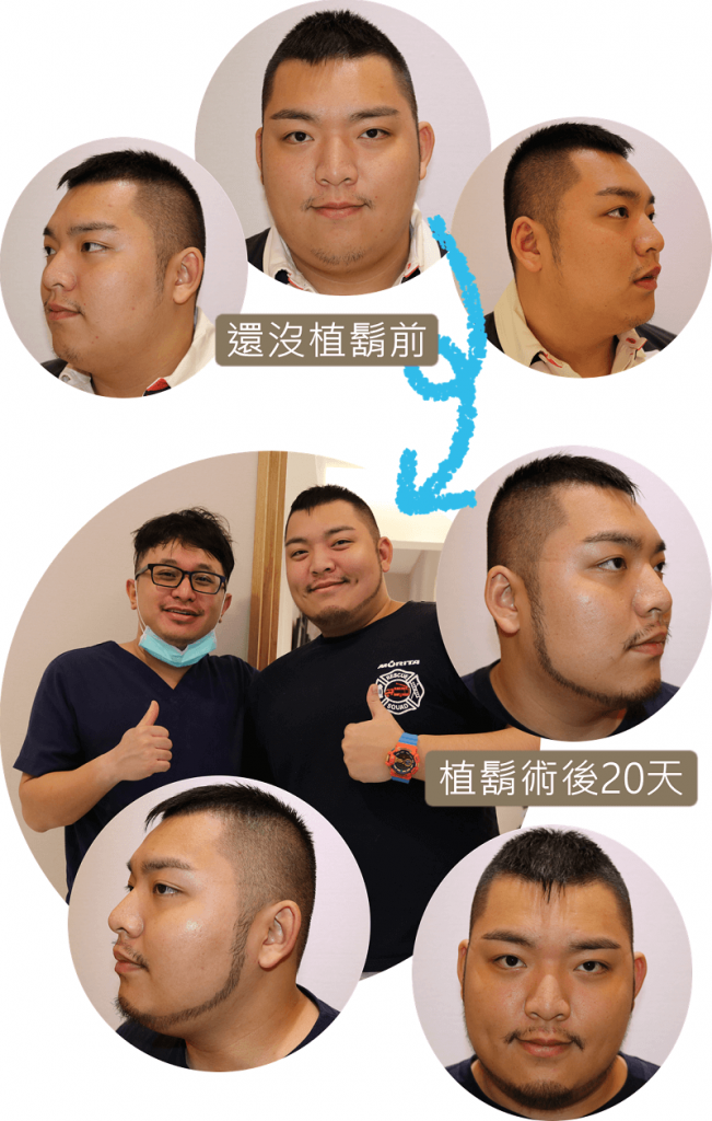 Show太郎植鬍前後對比圖