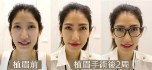 植眉 eyebrow transplant