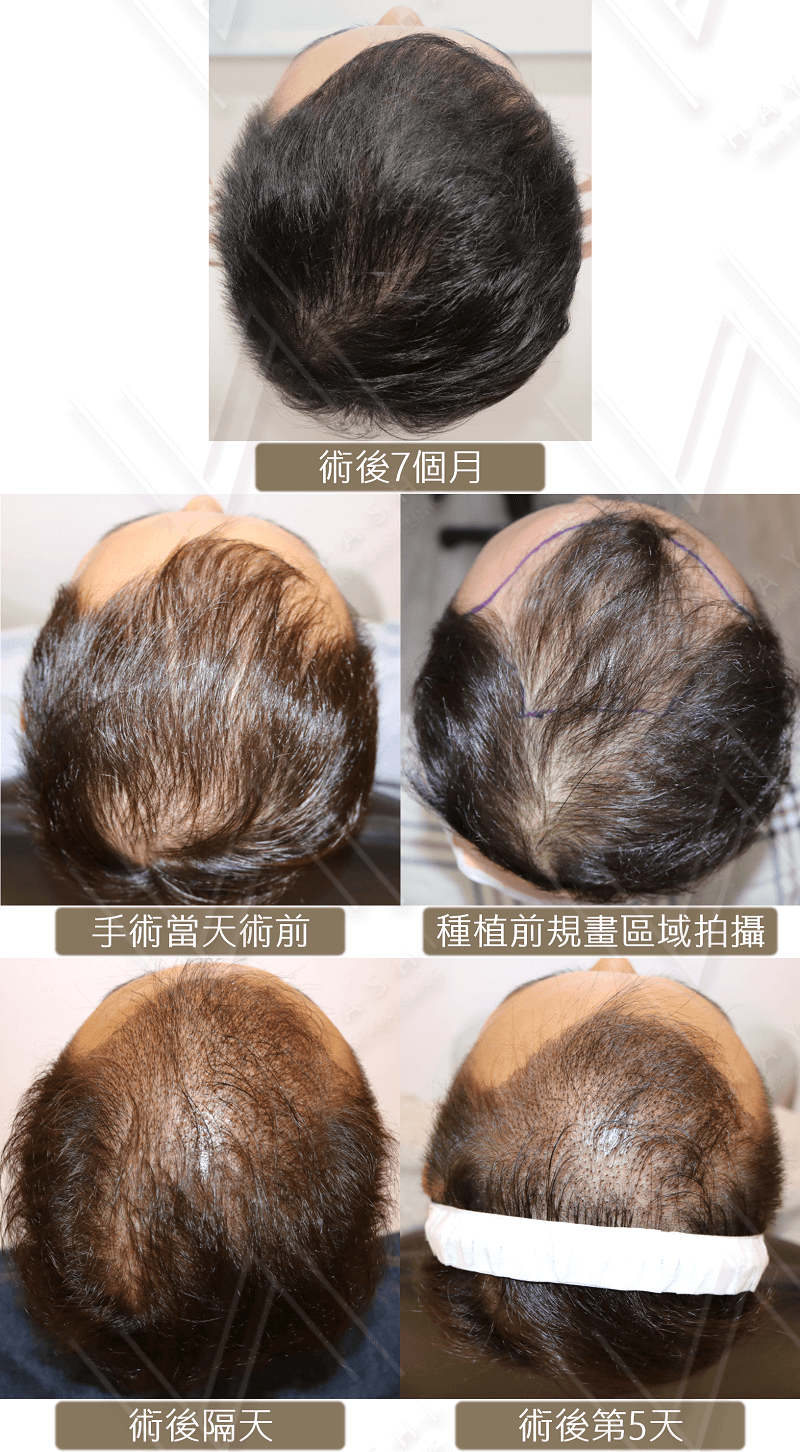 香港至台灣植髮手術案例照片