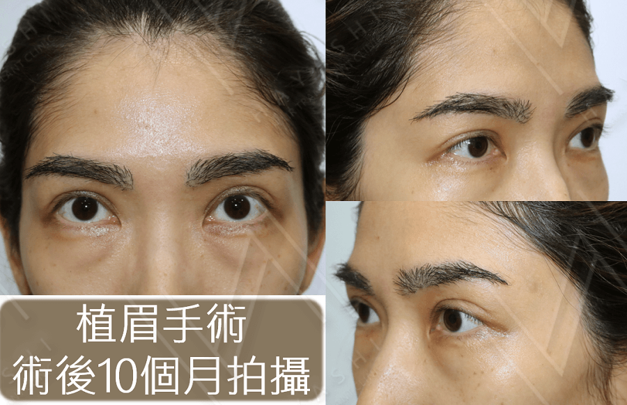 植眉 eyebrow transplant 10 months