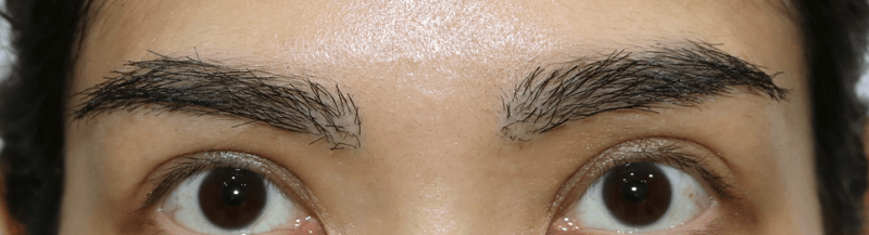 植眉 eyebrow transplant 10 months