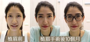 植眉 eyebrow transplant