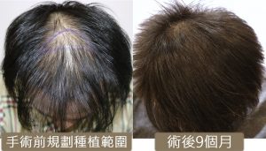 植髮心得 fue before and after