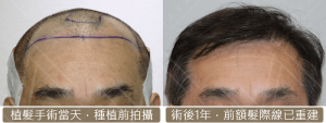 fue hair transplant 3112