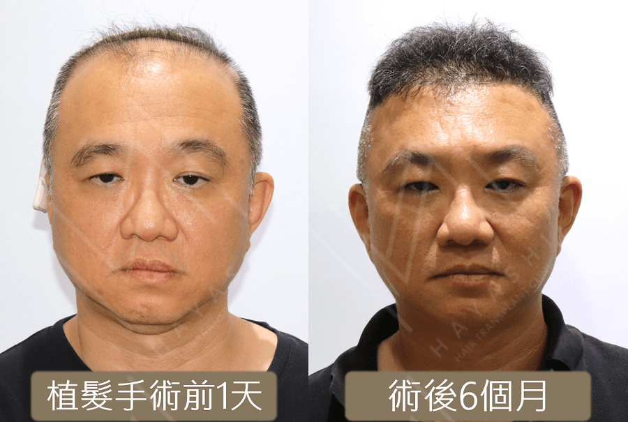 植髮心得 案例 術前術後6個月