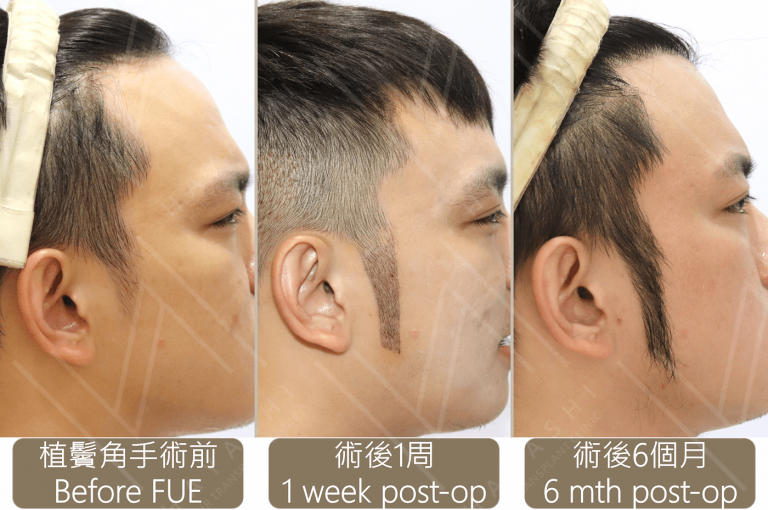 sideburn_4_s 秀冠植髮診所 HAYASHI Hair Transplant Clinic