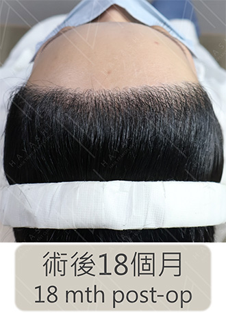 女生髮際線 植髮後