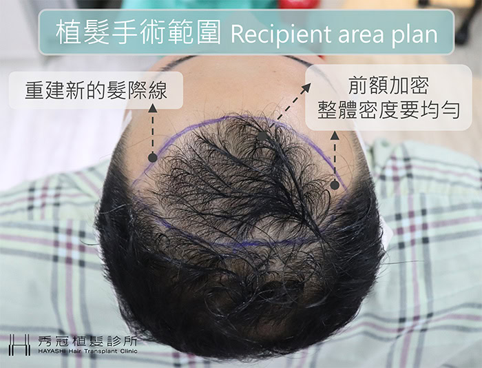 頭髮稀疏 前額植髮規劃