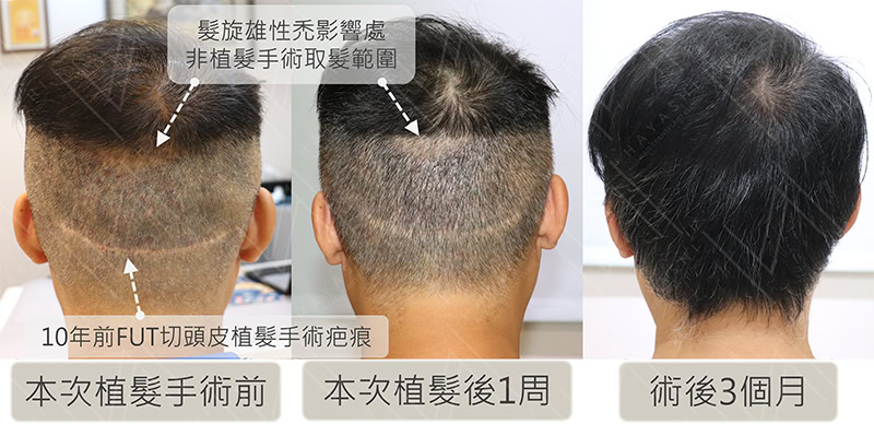 頭頂禿植髮 FUE FUT 傷口比較