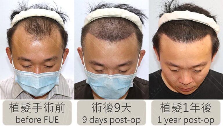 前額植髮