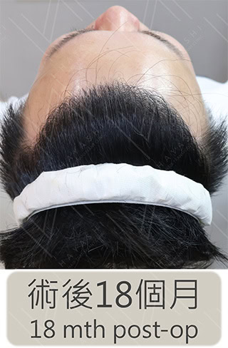 前額植髮 術後1年半