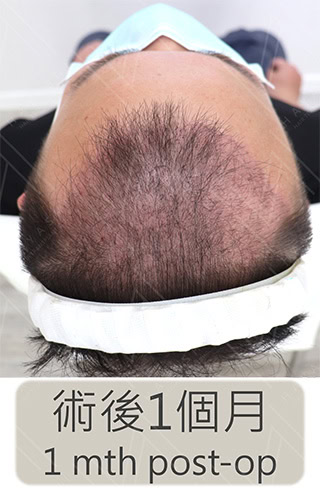 前額植髮 術後1個月