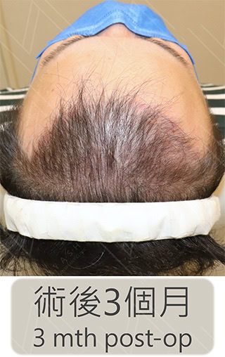 前額植髮 術後3個月