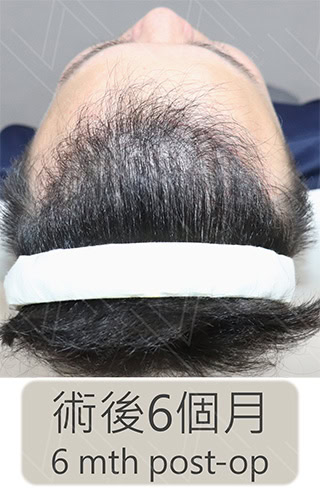 前額植髮 術後6個月