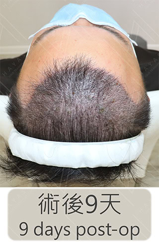 前額植髮 術後9天