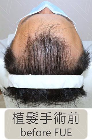 前額植髮前