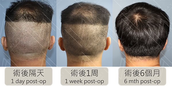 巨量植髮 後枕部取髮區 術後特寫