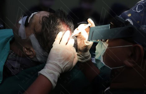 巨量植髮手術中