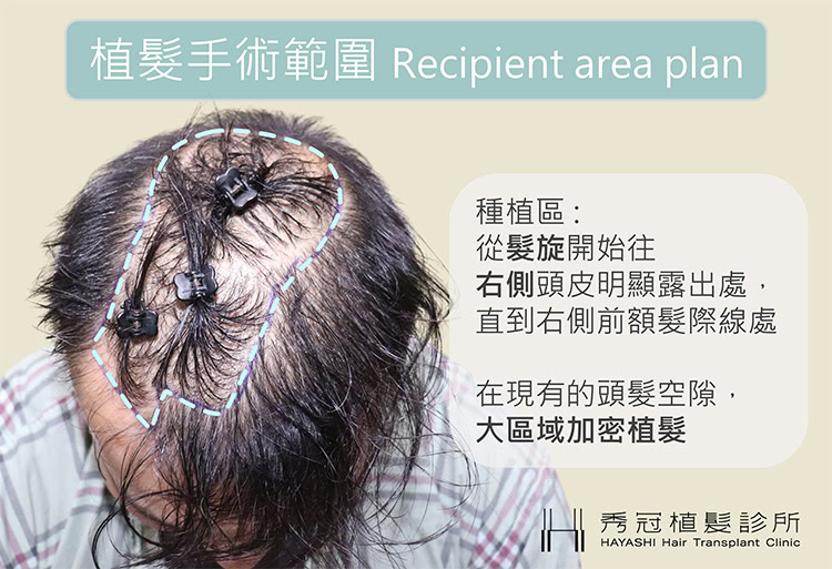 巨量植髮 講解