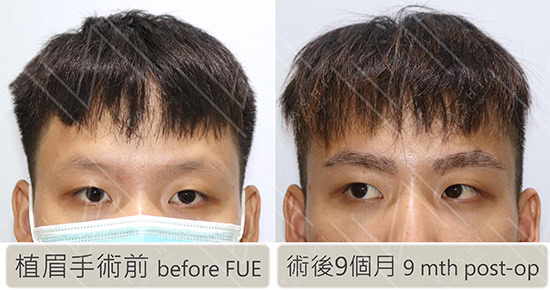 植眉案例，775根