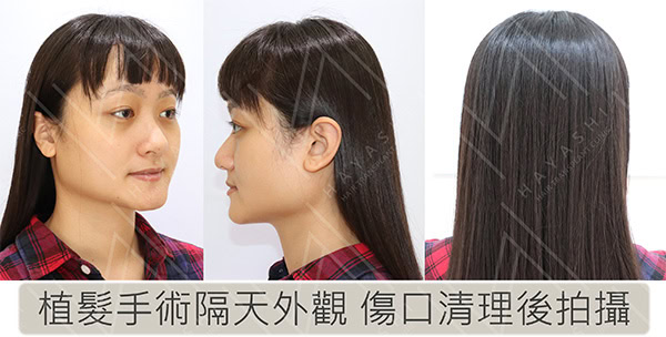 植髮隔天拆完紗布外觀