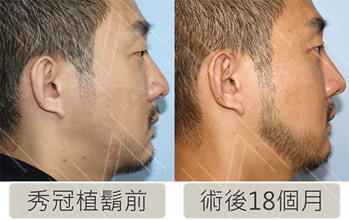植鬍案例前後對比照