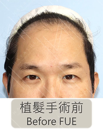 名人植髮心得,劉爾金植髮前