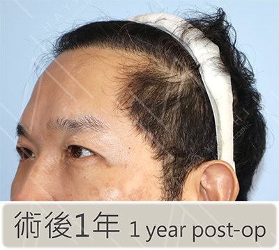 植髮後 左側