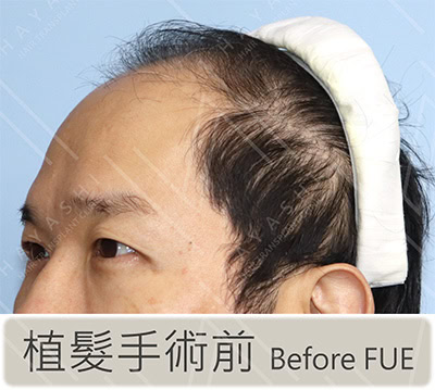 植髮前 左側