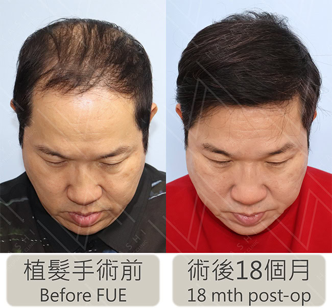 名人植髮心得
劉爾金植髮前後