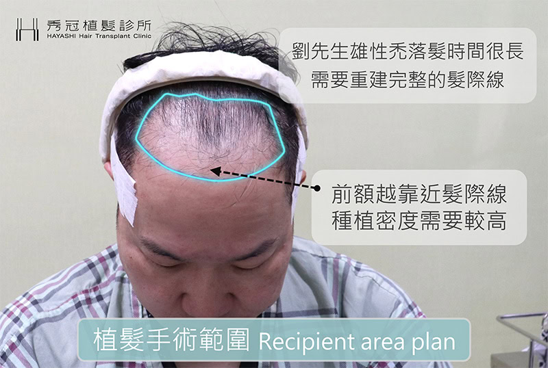 名人植髮心得 植髮規劃圖 劉爾金
