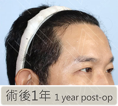 植髮後 右側