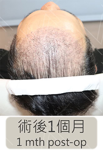植髮手術1個月