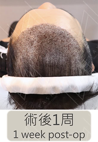 植髮手術1周