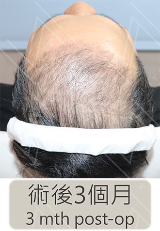 植髮手術3個月