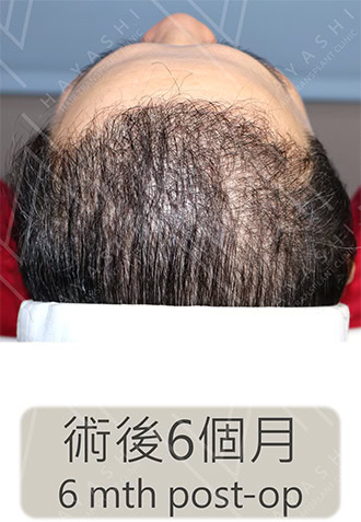植髮手術6個月
