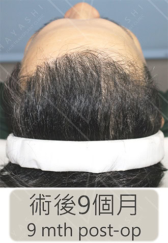 植髮手術9個月
