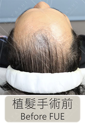 植髮前 名人植髮